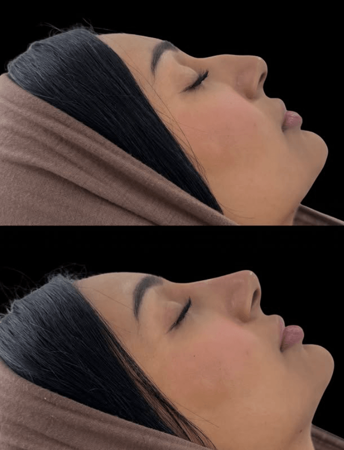 Liquid Rhinoplasty — 2